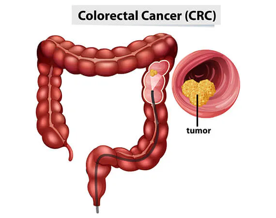Colorectal Cancer in Mumbai