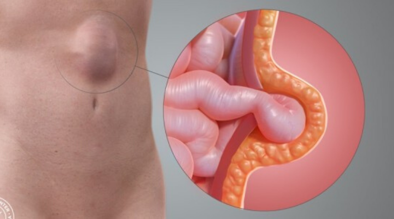 Hernia surgeon in Mumbai