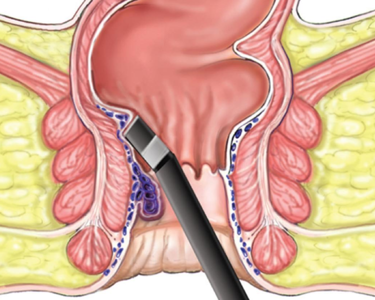 Fissure & Fistula Surgeon in Mumbai