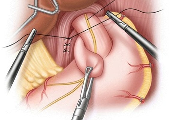 Fundoplication in Mumbai
