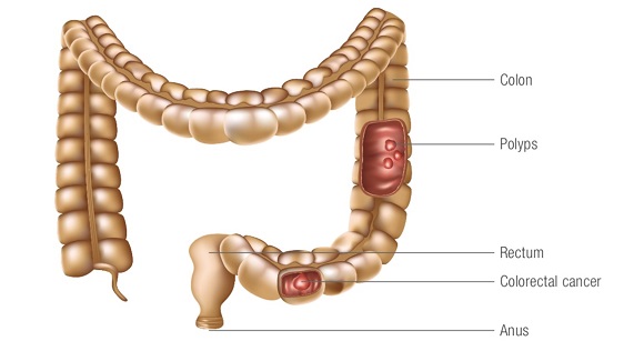 Colorectal Cancer Treatment
