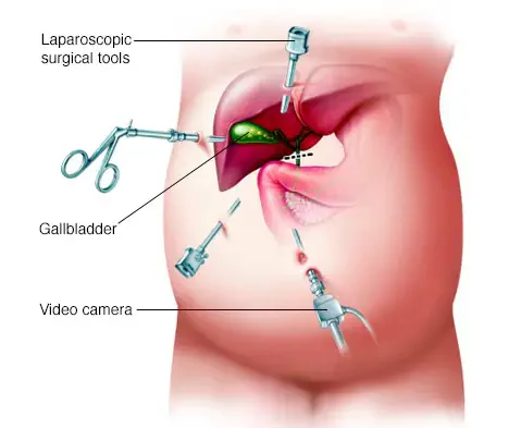 Cholecystectomy in Mumbai