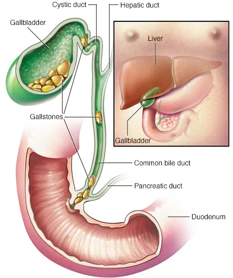 Cholecystectomy in Mumbai