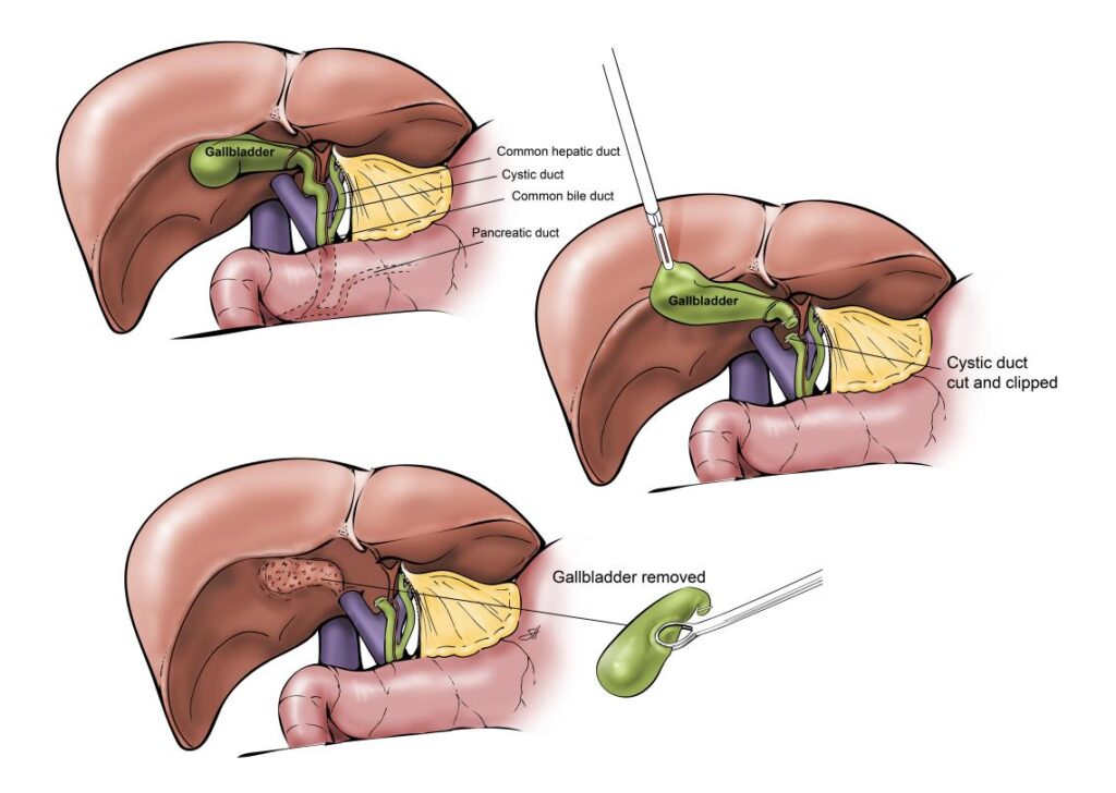 Gall bladder surgery in Mumbai