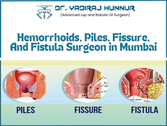 Hemorrhoids, Piles, Fissure, And Fistula Surgeon in Mumbai